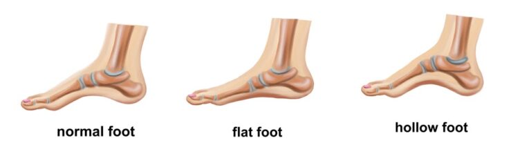 How To Tell If You Have Flat Feet 