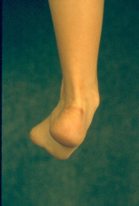 foot supination